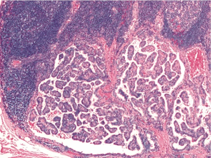 Câncer de Tireoide Tem Cura? Taxa de Cura de 99% | Guia Completo 2026