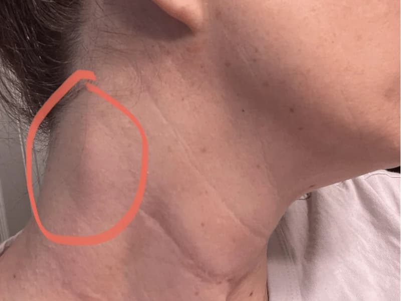 Câncer de Tireoide: Sintomas, Diagnóstico e Tratamento Completo | 2026