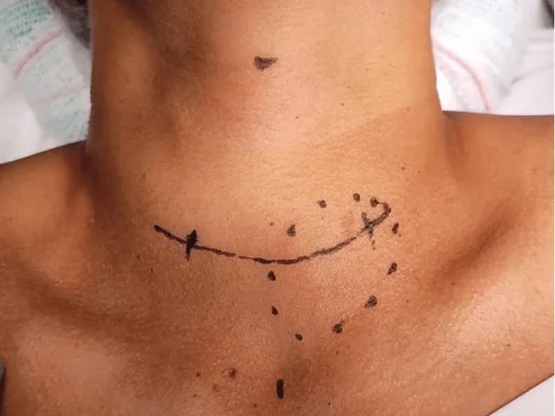 Nódulo na Tireoide: É Grave? | Guia 2026