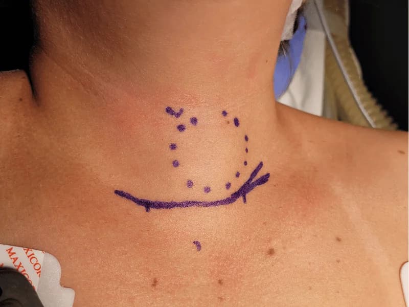 Nódulo Benigno na Tireoide: Quando Operar? Indicações ATA 2026