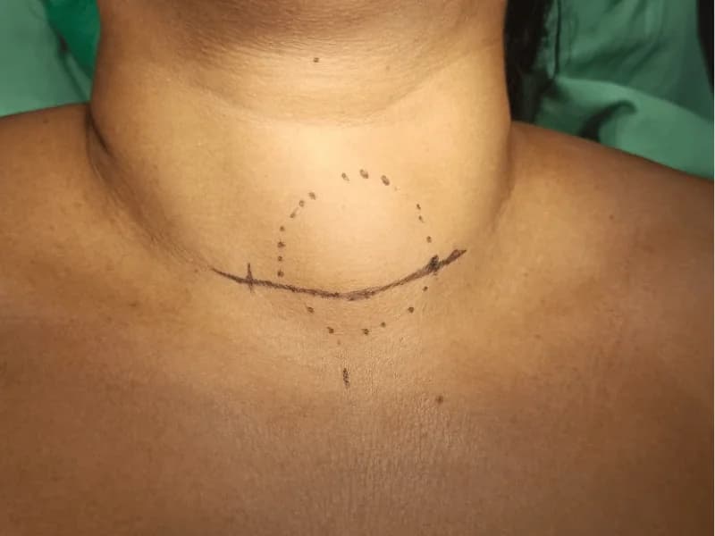 Quando Puncionar Nódulo na Tireoide? TI-RADS e Indicações | 2026