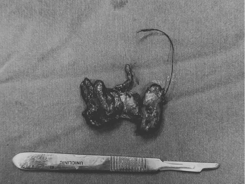 O Tumor Tinha 7 Milímetros — e a Biópsia Pediu Mais Tratamento