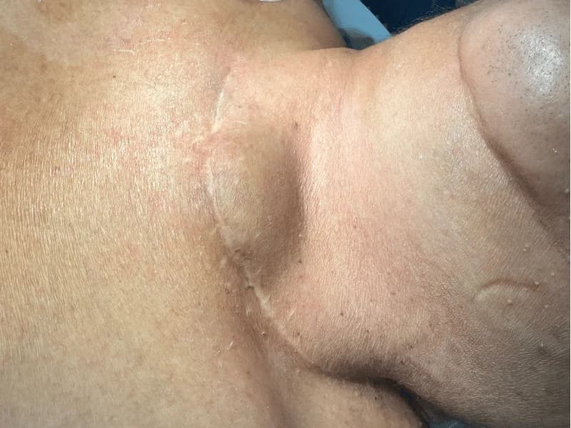 "Vamos Precisar Operar Novamente": Quando a Primeira Cirurgia Ficou Incompleta