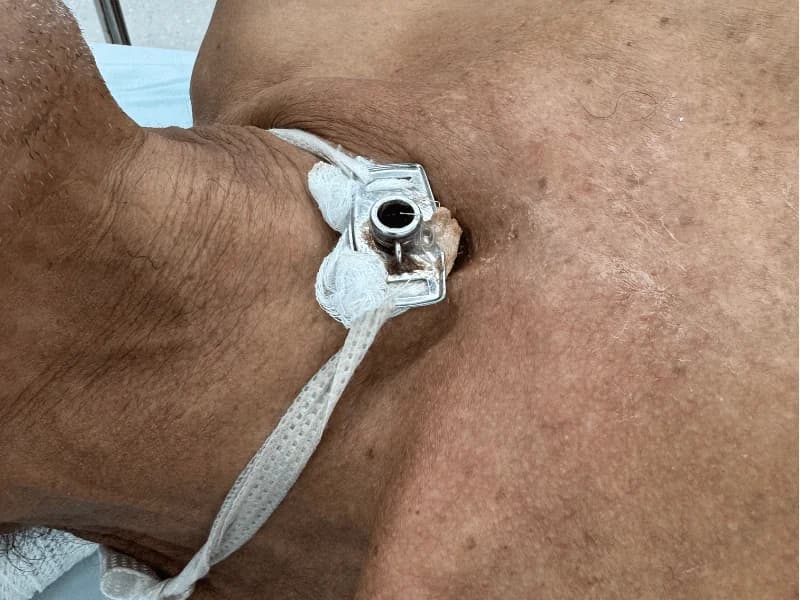 Traqueostomia Após Tireoidectomia: Quando Necessária e Recuperação | Guia 2026