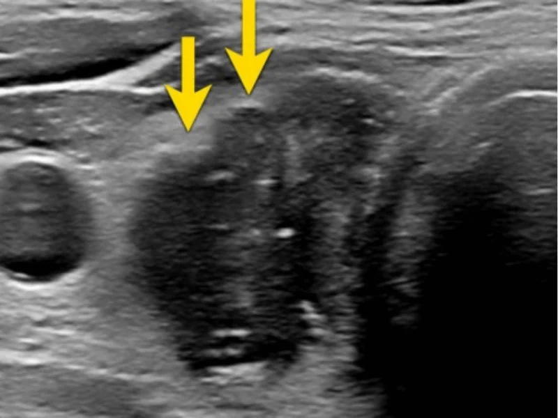 Nódulo na Tireoide no Ultrassom: E Agora? | 2026