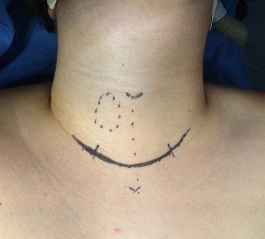 Cirurgia de tireoide com equipe especializada