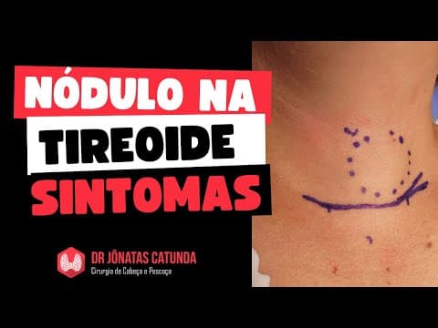 Sintomas dos nódulos na tireoide - Ao vivo respondendo perguntas