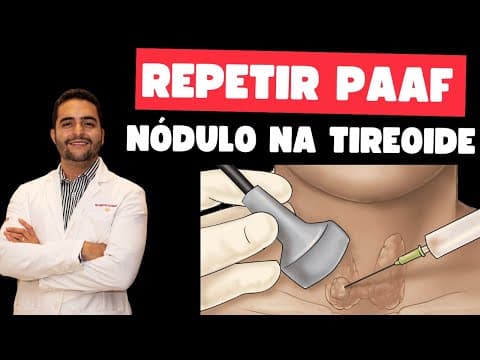Quando precisa repetir a PAAF - punção aspirativa por agulha fina da tireoide