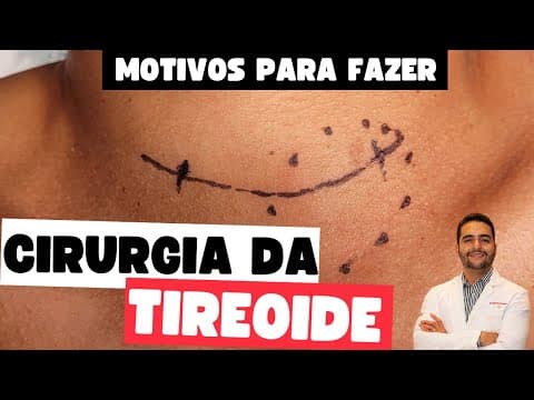 Quando o nódulo na tireoide precisa de cirurgia: entenda os critérios e riscos