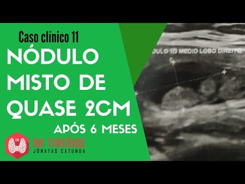 Nódulo misto de quase 2cm na tireóide - Caso Clínico Dr Jônatas Catunda