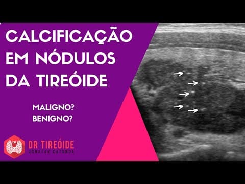 Calcificação em nódulos da tireóide - Microcalcificações? Macrocalcificações?