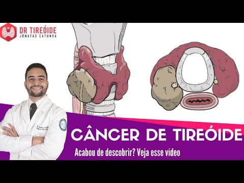 Câncer de Tireóide - Vídeo para quem acabou de descobrir! | Dr Jônatas Catunda