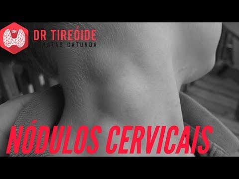 Nódulos cervicais - Saiba o que pode ser! | Dr Jônatas Catunda