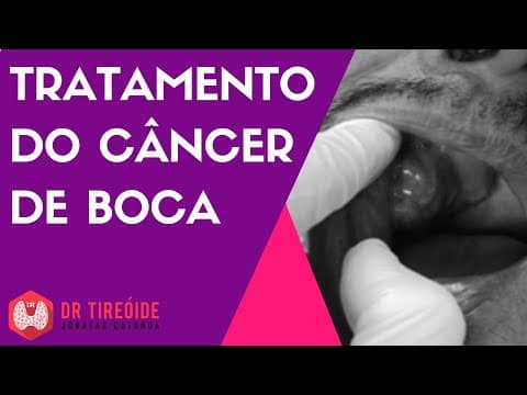 Tratamento do câncer de boca - Dr Jônatas Catunda