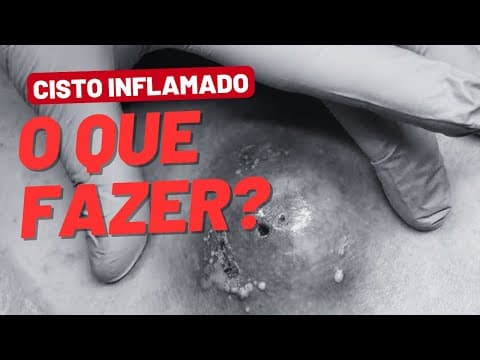 Cisto inflamado e dolorido: o que fazer agora