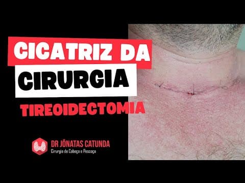 Cicatriz da cirurgia da tireóide - tireoidectomia total / tireoidectomia parcial