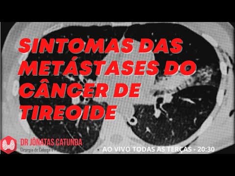 Sintomas das metástases do câncer de tireoide - Vídeo ao vivo respondendo dúvidas