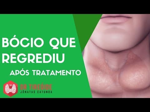 Bócio que regrediu após tratamento do hipotireoidismo - Caso Clínico Dr Jônatas Catunda