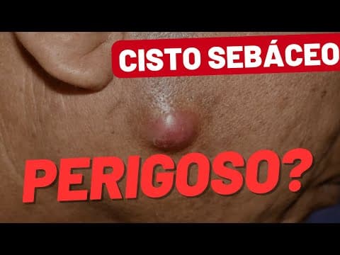 Cisto sebáceo - Sinais de alerta!