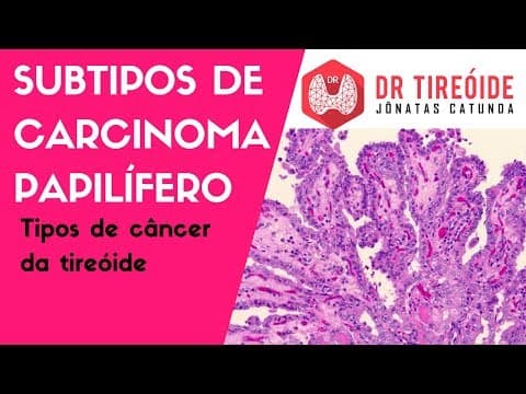 Subtipos do Carcinoma Papilífero - Variante folicular? Variante células altas? | Dr Jônatas Catunda