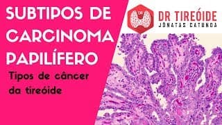 Subtipos do Carcinoma Papilífero - Variante folicular? Variante células altas? | Dr Jônatas Catunda