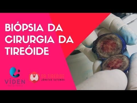 Como é feita a biópsia da cirurgia da tireóide?
