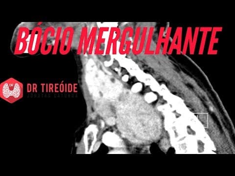 Bócio Mergulhante - Quando a tireóide cresce demais! | Dr Jônatas Catunda