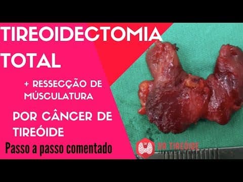 Tireoidectomia total por câncer de tireóide - Cirurgia Passo a passo | Dr Jônatas Catunda
