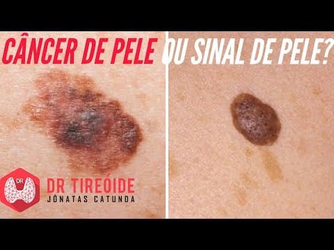 Sinais do Câncer de Pele - Melanoma X Sinal de pele | Dr Jônatas Catunda