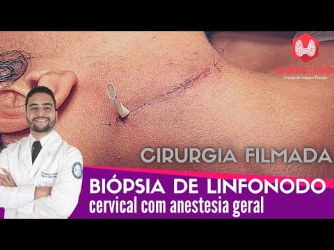 Biopsia de linfonodo no pescoço com anestesia geral