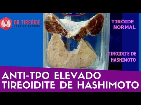 Anti-TPO elevado - Tireoidite de Hashimoto? - Dr Tireóide responde