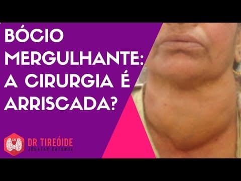 Bócio mergulhante - a cirurgia é arriscada?