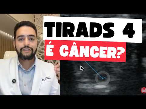 TIRADS 4 na Tireoide — Precisa Operar? Risco Real de Câncer? | Dr. Jônatas Catunda