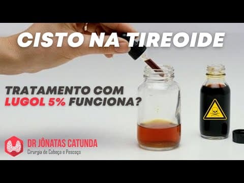 Lugol 5% para tratar cisto na tireóide: coisa do passado