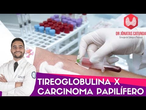 Tireoglobulina X Carcinoma papilífero