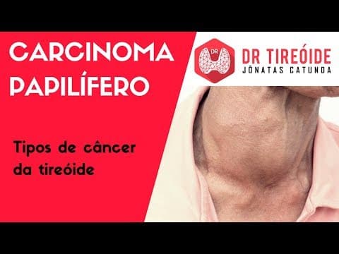 Carcinoma papilífero - Tipos de câncer de tireóide | Dr Jônatas Catunda