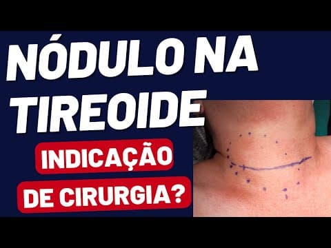 Nódulo na tireoide - quando tem que operar? Câncer, Bócio, Hipertireoidismo