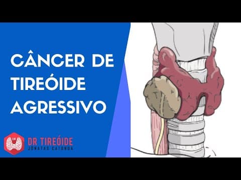 Câncer de tireóide agressivo - Dr Tireóide responde