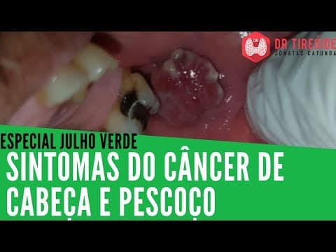 Julho Verde - Sintomas do Câncer de Cabeça e Pescoço
