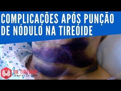 Complicações após punção de nódulo na tireóide | Dr Tireóide Responde
