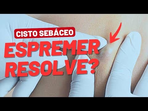 Espremer resolve? Quando operar um cisto e evitar volta