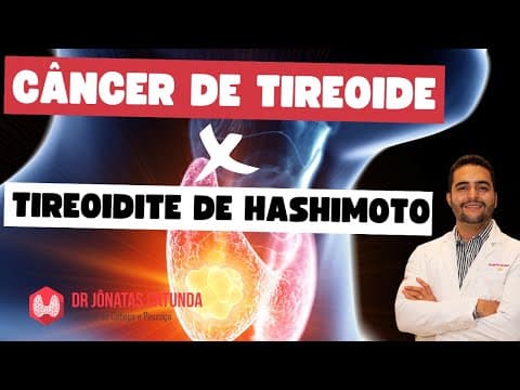 Artigo encontra relação entre Tireoidite de Hashimoto e Câncer de tireóide