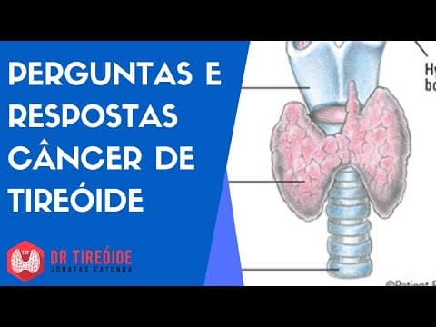 Perguntas e respostas sobre Câncer de tireóide - Live Dr Jônatas Catunda - Dr Tireóide responde