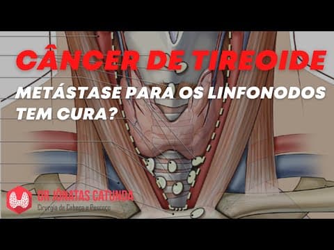 Metástase para o linfonodo tem cura? | Câncer de tireoide
