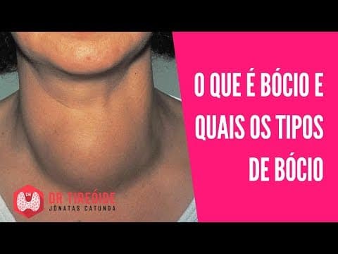 Bócio - O que é, Tipos de Bócio (multinodular, difuso) | Dr Jônatas Catunda