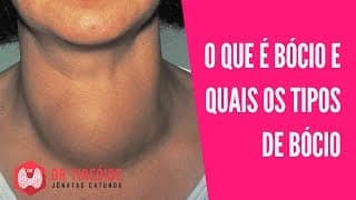 Bócio - O que é, Tipos de Bócio (multinodular, difuso) | Dr Jônatas Catunda