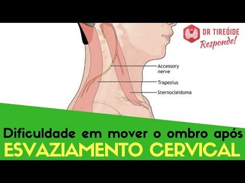 Dificuldade em mover o ombro após esvaziamento cervical - Dr Tireóide Responde