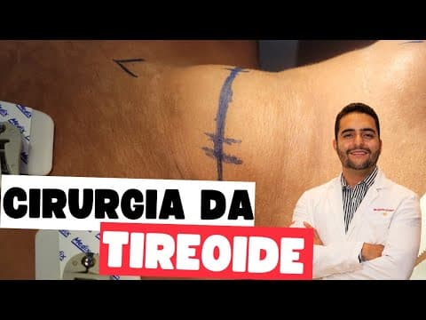 Tireoidectomia total - Riscos, complicações / Hiperparatireoidismo secundário