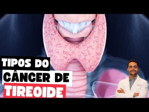 Conheça os tipos de câncer de tireoide: saiba mais sobre sintomas e tratamentos