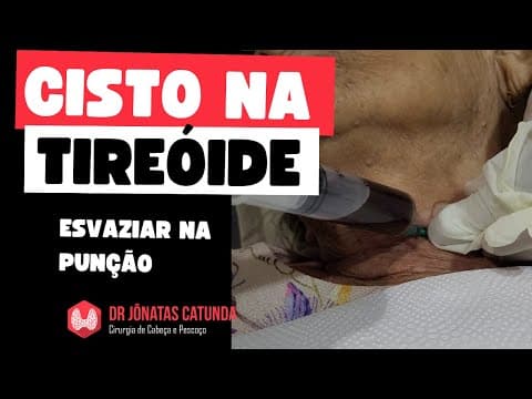 Tratamento do cisto na tireoide volumoso